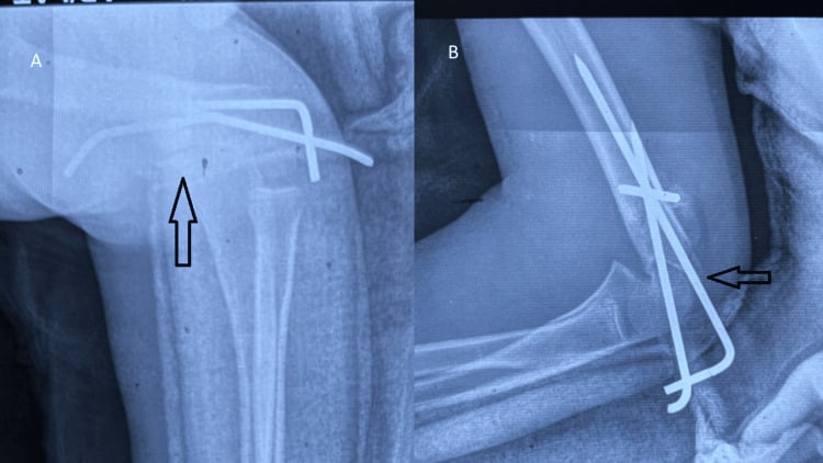 Immediate postoperative AP and lateral radiographs showing stable distal humerus fixation