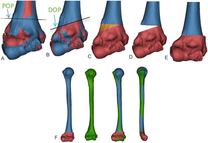 Schematic of proximal and distal osteotomy planes around the distal humerus