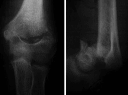 AP and lateral radiographs of a neglected flexion-type supracondylar humerus fracture