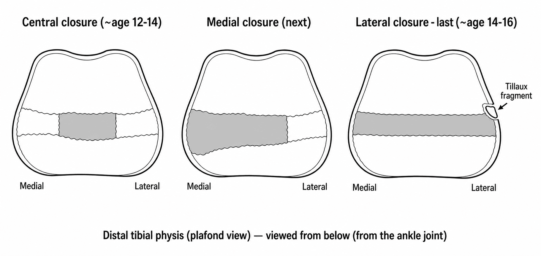 Schematic of the asymmetric central-medial-lateral closure pattern of the distal tibial physis and the Tillaux fragment