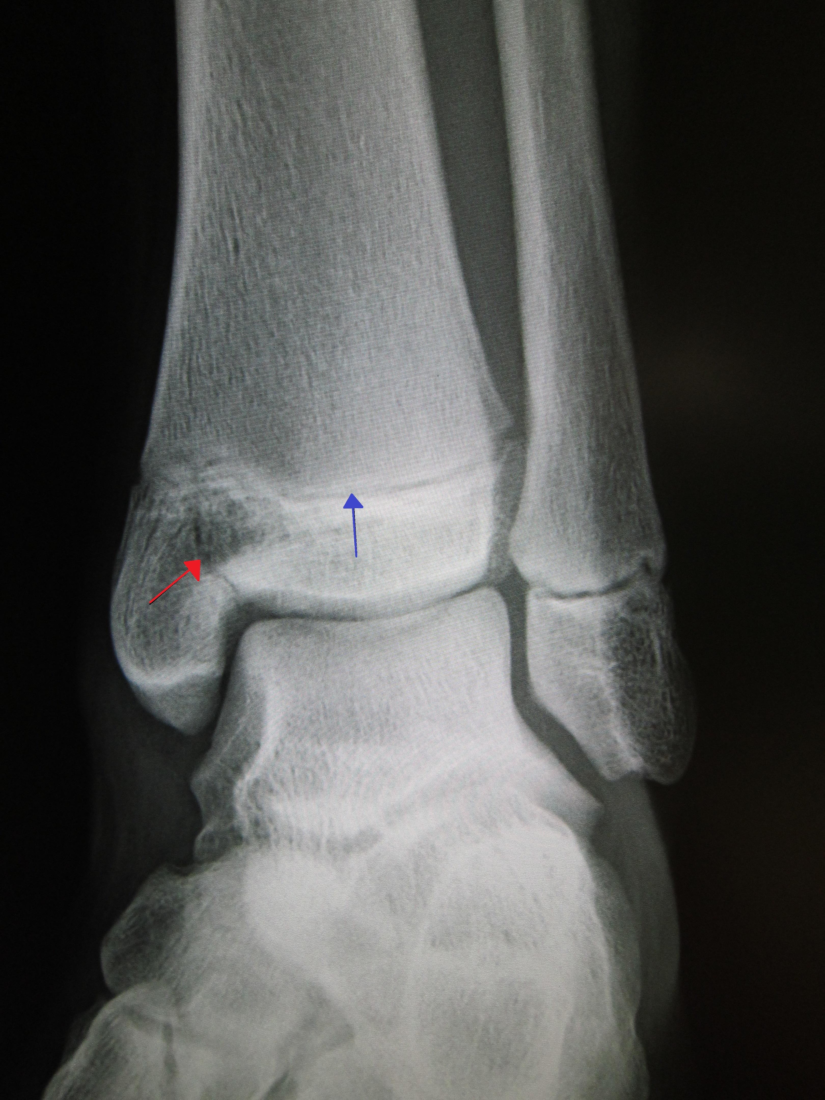 Salter-Harris type III fracture of medial malleolus X-ray