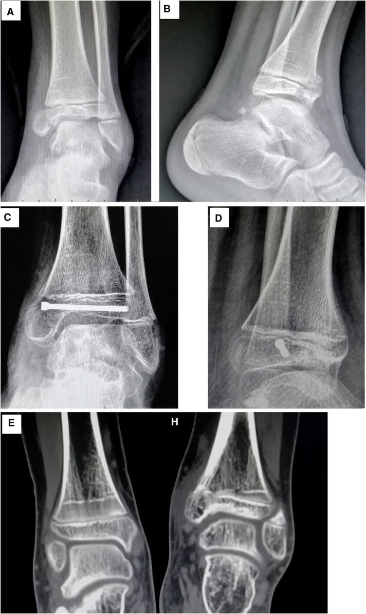 Serial radiographs and coronal CT of both ankles showing a distal tibial Salter-Harris IV fracture progressing to a convergent growth-arrest line and early medial physeal bar