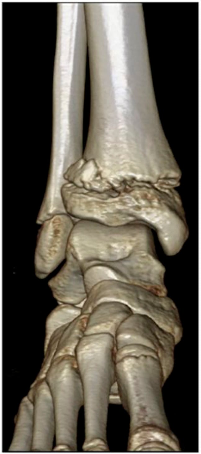 Three-dimensional CT reconstruction of a Salter-Harris type II distal tibial fracture with a metaphyseal fragment beside the fibula
