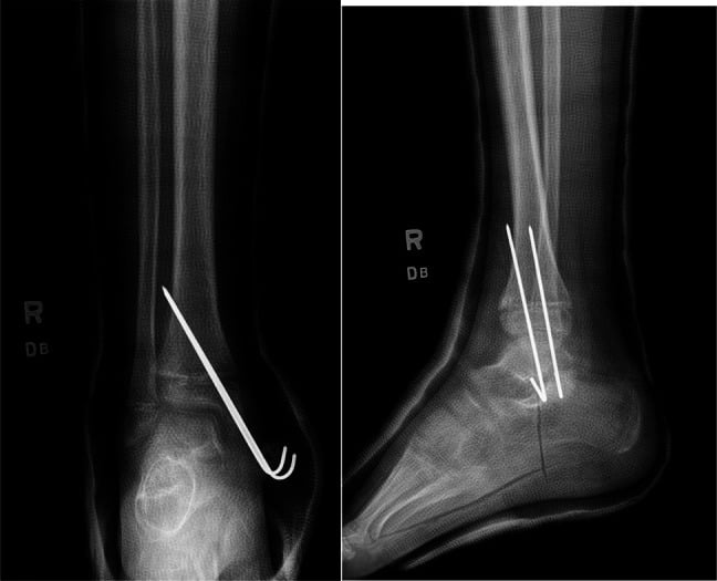 AP and lateral ankle radiographs showing smooth K-wire fixation of a displaced distal tibial physeal fracture