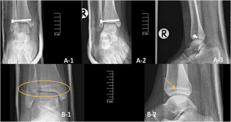 Postoperative ankle radiographs showing epiphyseal screw fixation of Tillaux fractures with metal and radiolucent implants