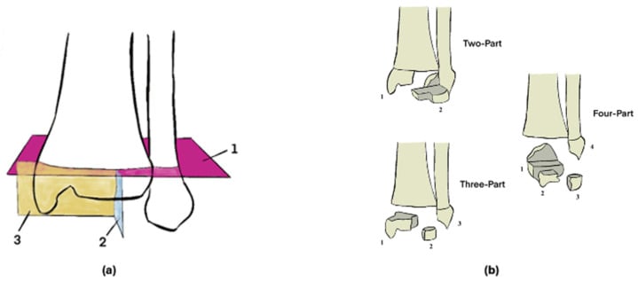 Schematic showing (a) the three numbered fracture planes of a triplane fracture and (b) its two-, three- and four-part patterns with numbered fragments