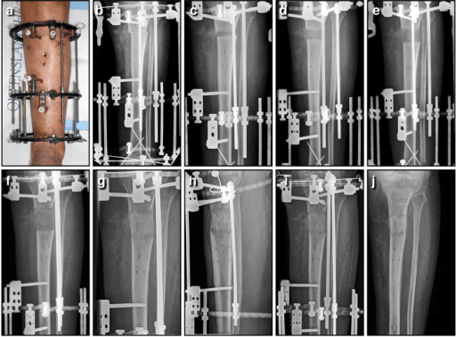 Ilizarov distraction osteogenesis for tibial bone defect - clinical and serial X-ray progression