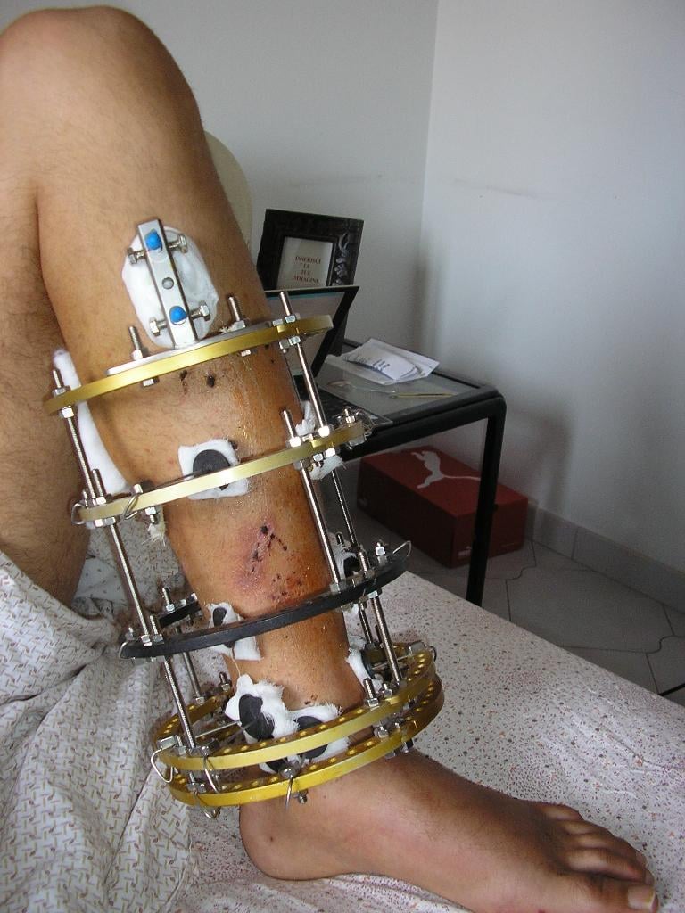 Ilizarov circular external fixator on lower leg
