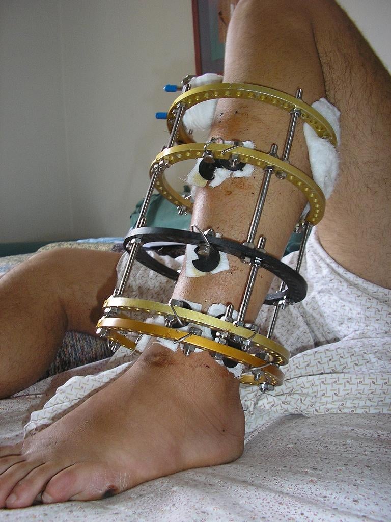 Ilizarov external fixator alternate view