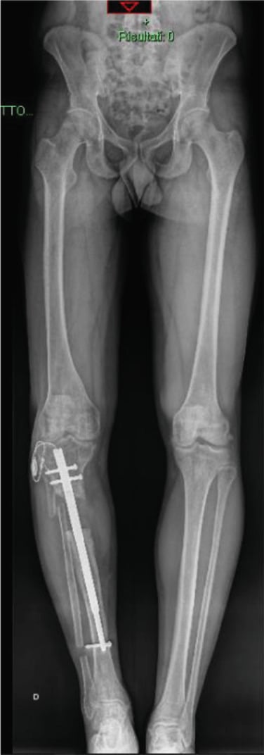Long-leg radiograph with a motorised intramedullary lengthening nail in the right tibia