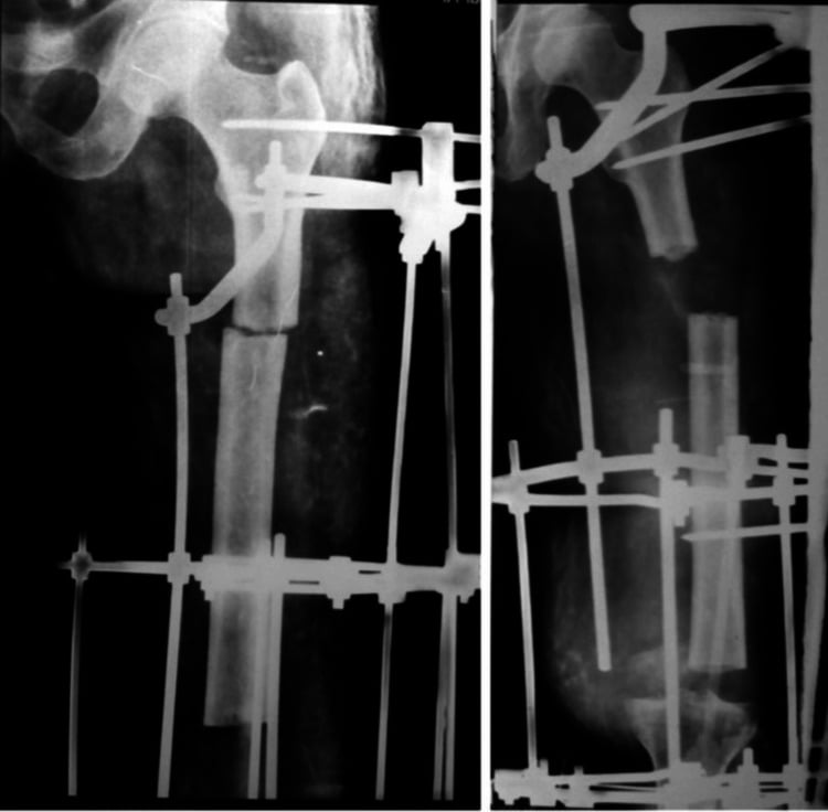 Serial radiographs showing progressive varus angulation of a transported femoral segment
