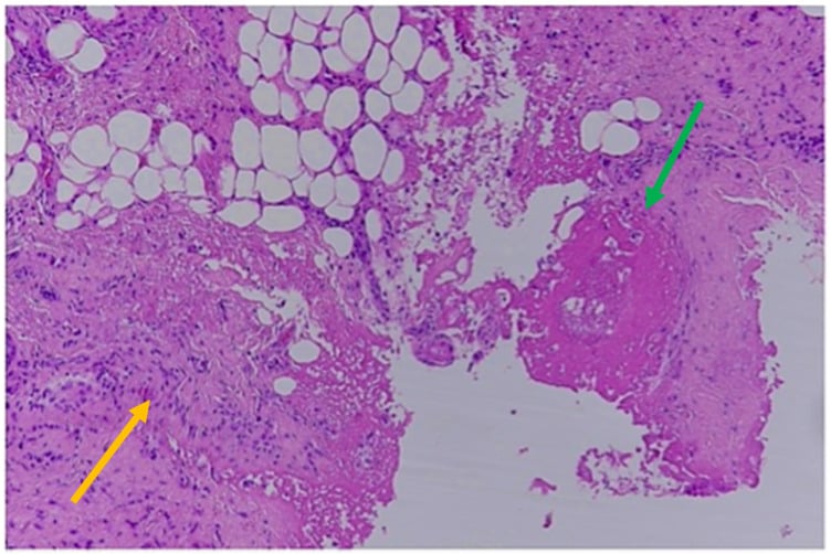 Histology of an approximately five-day-old bruise showing granulation tissue and inflammatory cells