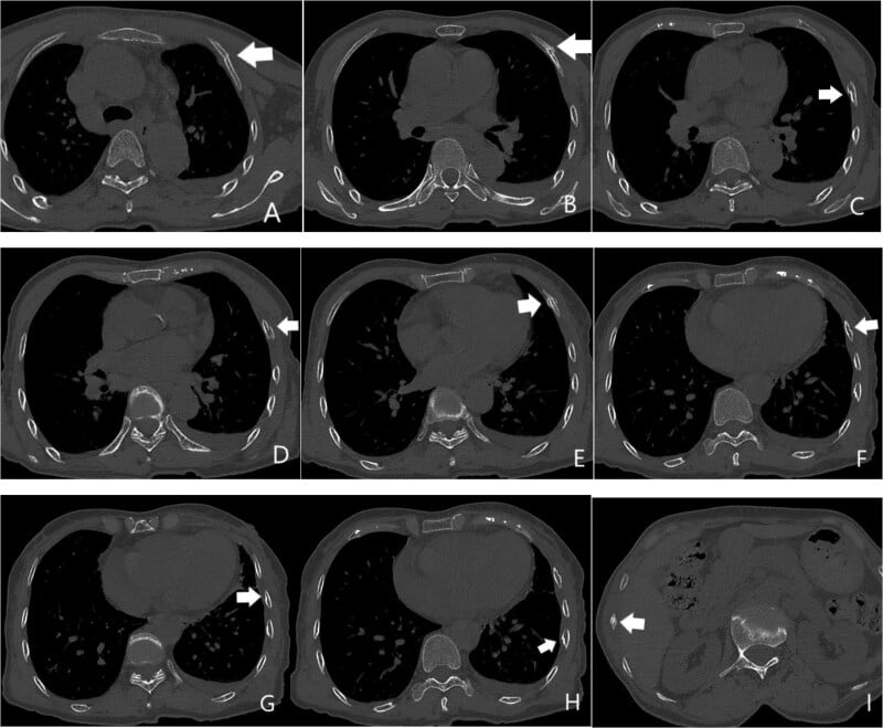 Axial chest CT demonstrating rib fractures of varying healing ages in elder abuse
