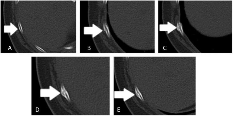 Radiographic classification framework for fracture healing stages in elder abuse