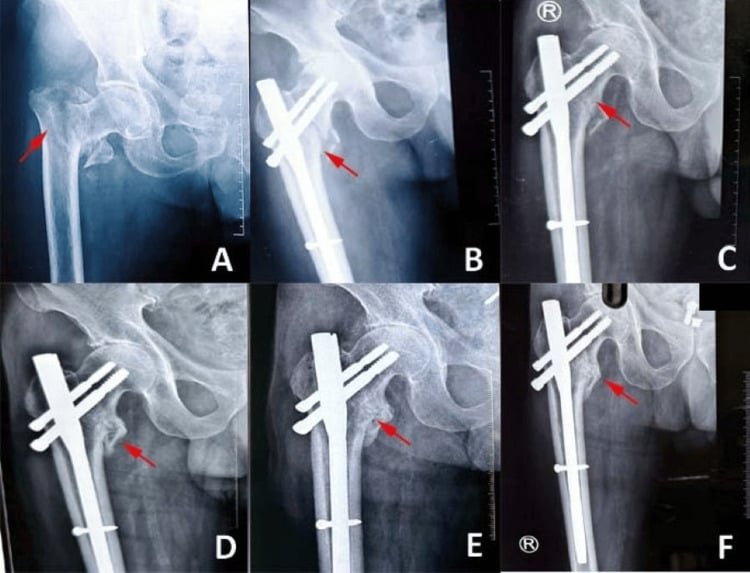 Serial radiographs showing fixation and healing of an intertrochanteric fragility fracture