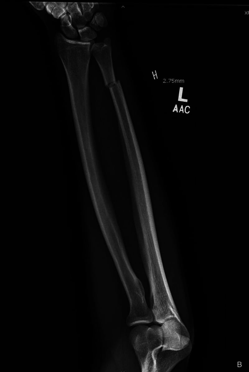 Anteroposterior radiograph showing an isolated left ulnar shaft fracture