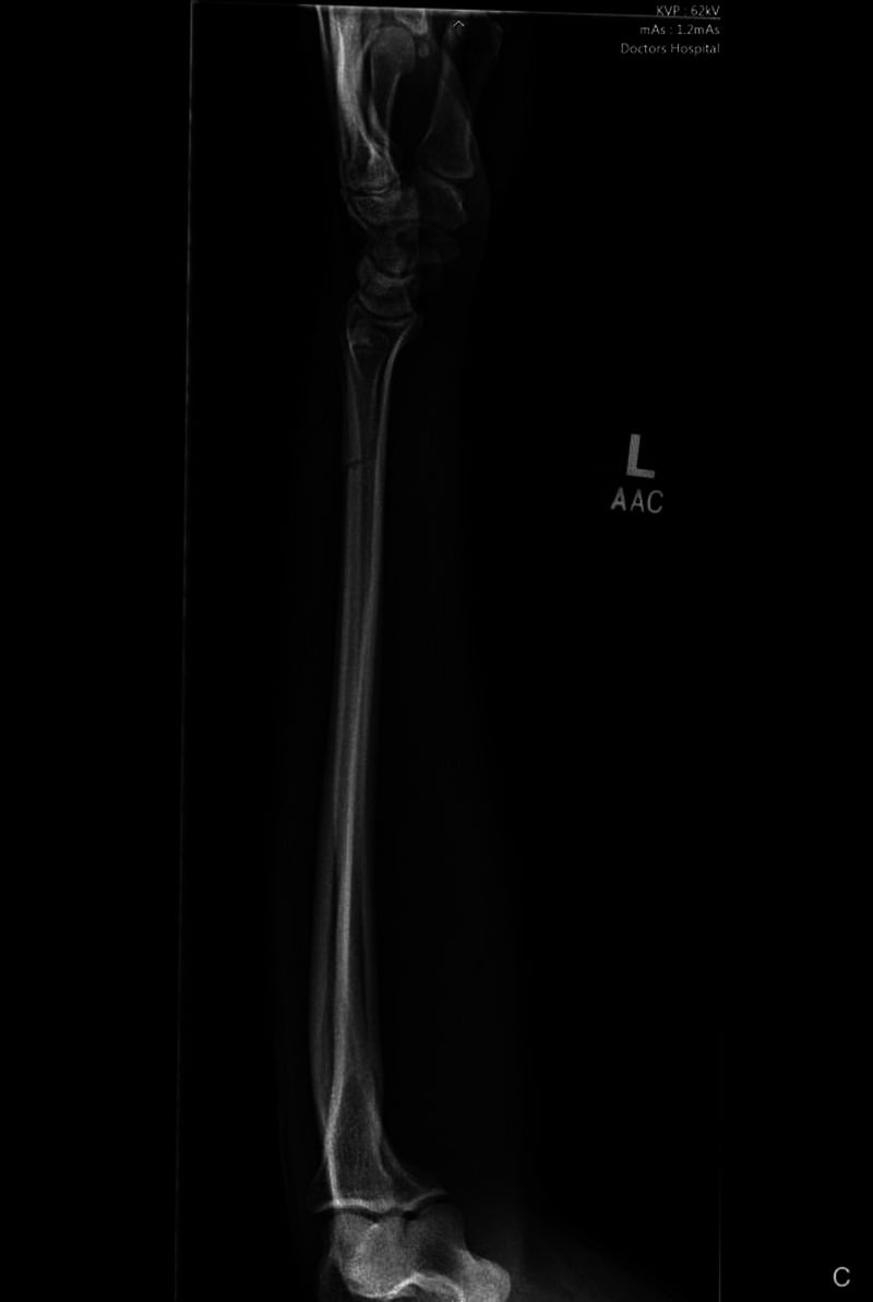 Lateral radiograph showing an isolated left ulnar shaft fracture