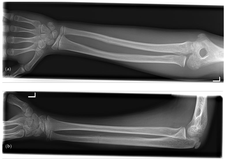 Paired forearm radiographs showing an isolated transverse ulnar shaft fracture