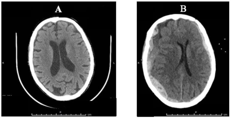 Axial head CT comparison showing interval development of a large subdural haematoma