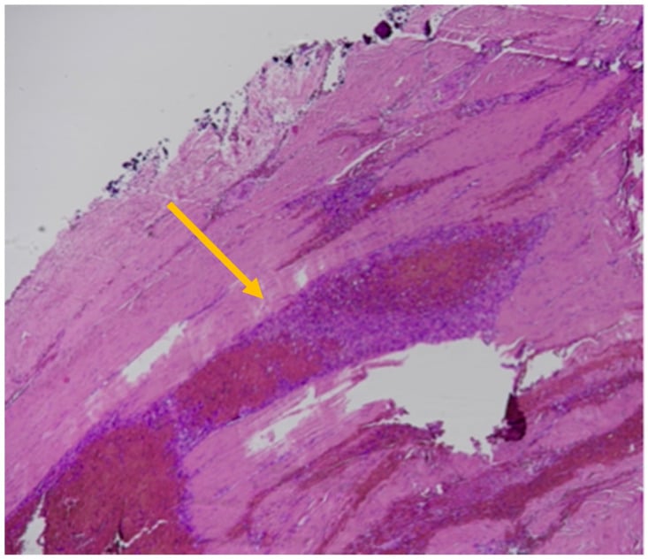 Histology of a subacute subdural haematoma showing fibroblasts and clot organisation