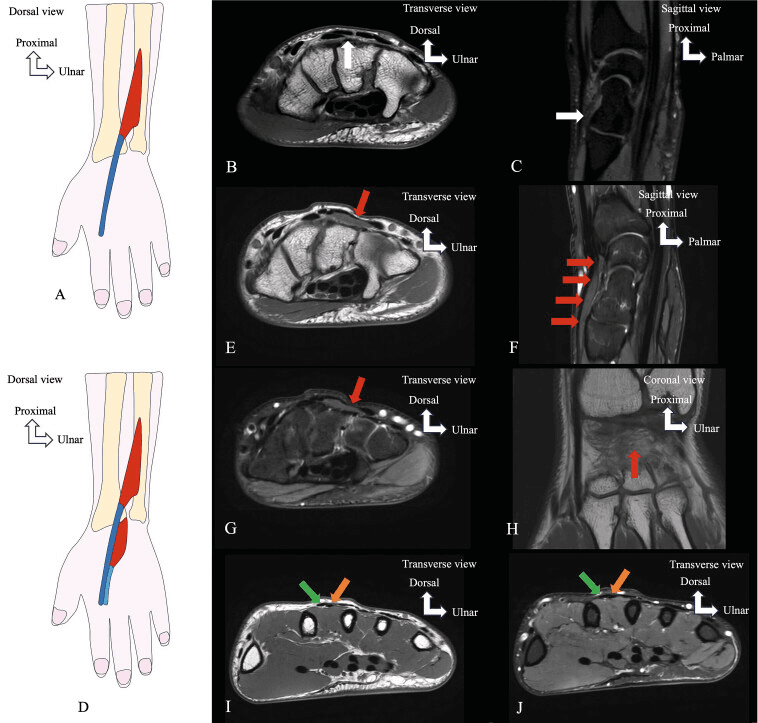Schematic and MRI of an extensor indicis variant with muscle tissue present within the dorsal carpal compartment
