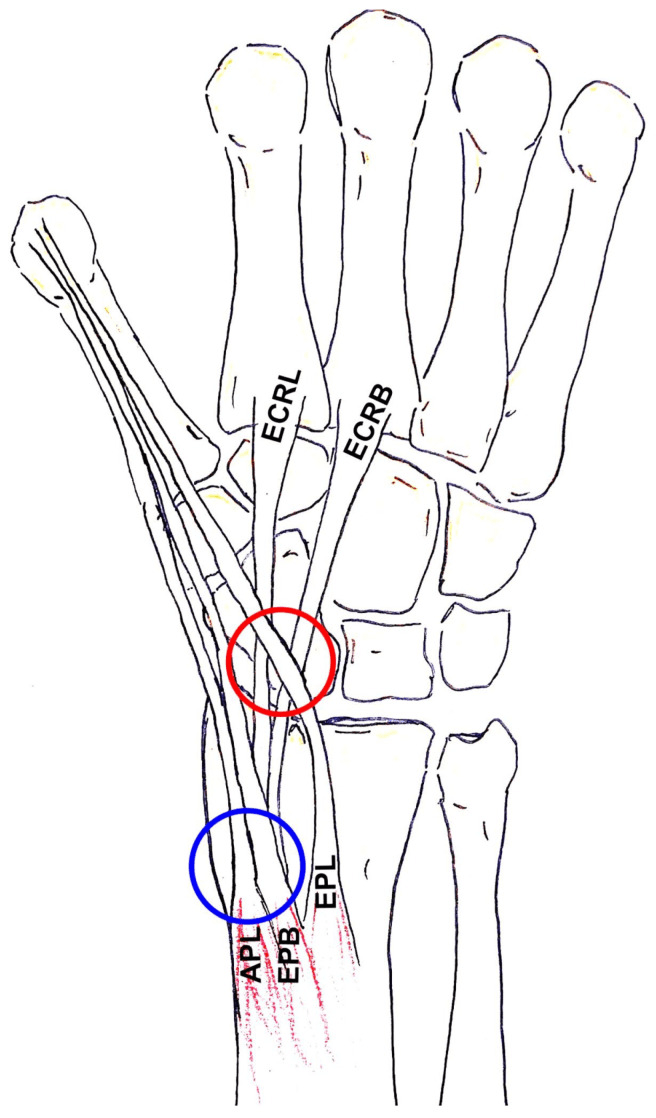 Diagram of the dorsal wrist and forearm marking the distal intersection of the third compartment with the second and the proximal intersection of the first with the second compartment