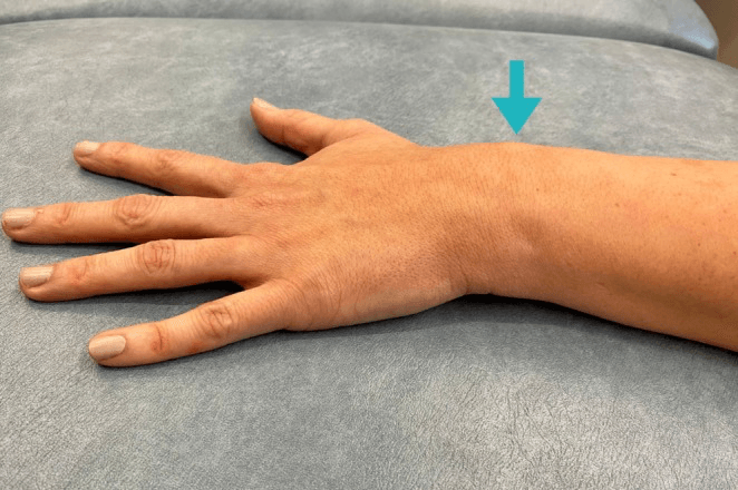 Photograph of the dorsal forearm showing a mildly raised contour approximately four centimetres proximal to Lister tubercle in intersection syndrome