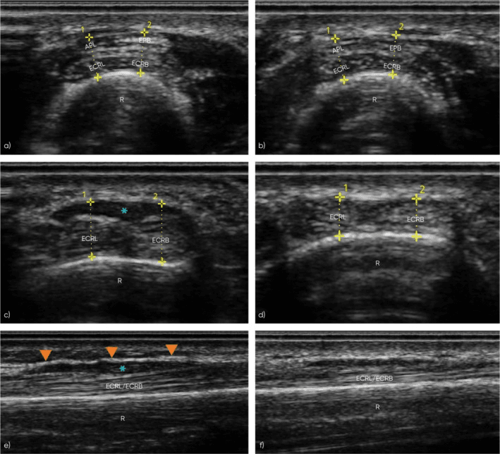 Short-axis and long-axis ultrasound images comparing the symptomatic and asymptomatic forearms at the proximal intersection