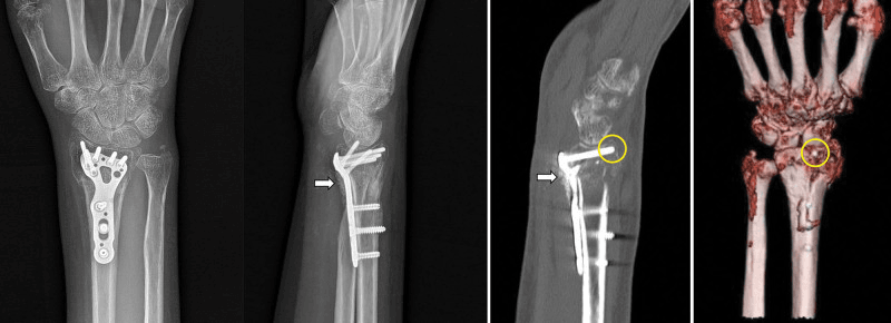 Radiograph and CT of a volar plate with a distal screw protruding beyond the dorsal cortex of the radius