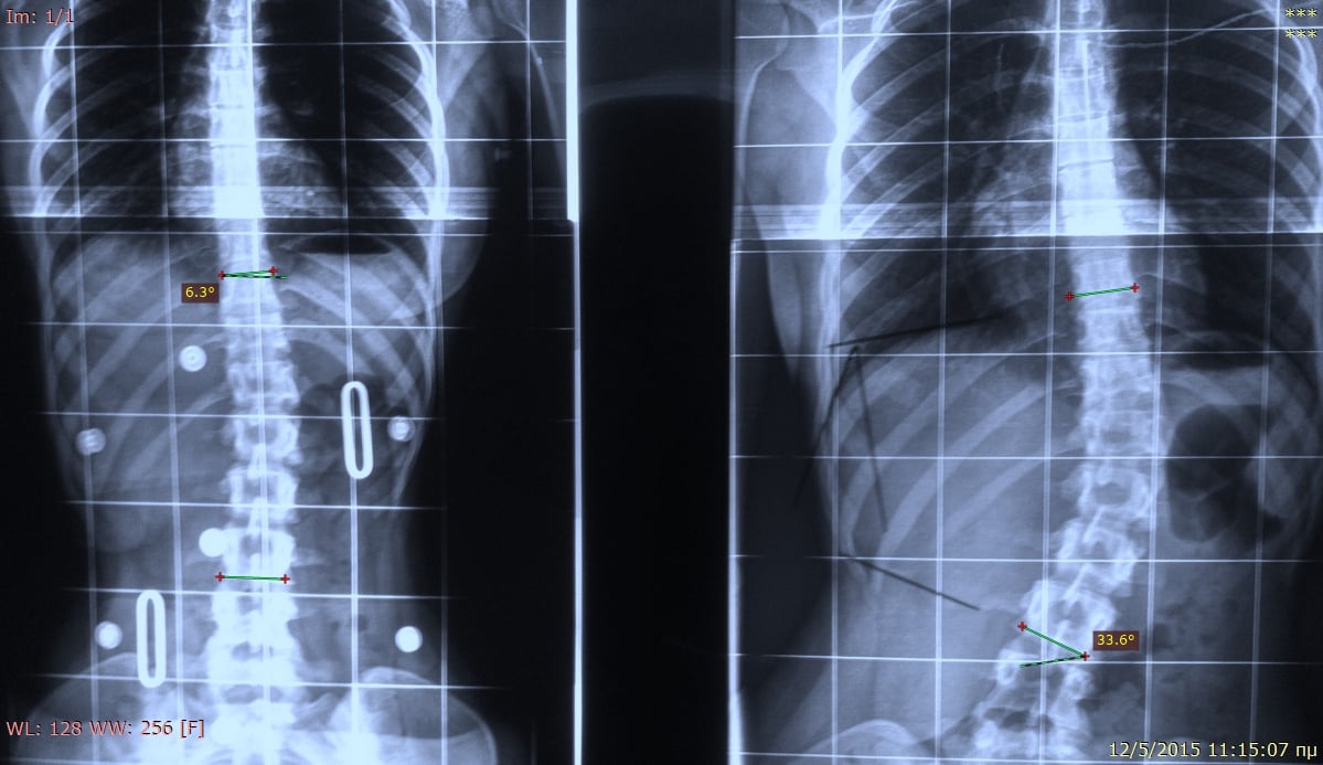 Standing AP spine radiographs showing scoliosis treatment with Cobb angle measurements