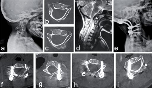 Multimodal imaging and surgical treatment of cervical instability in a pediatric patient