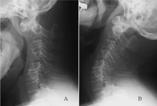 Flexion-extension cervical radiographs demonstrating atlantoaxial instability