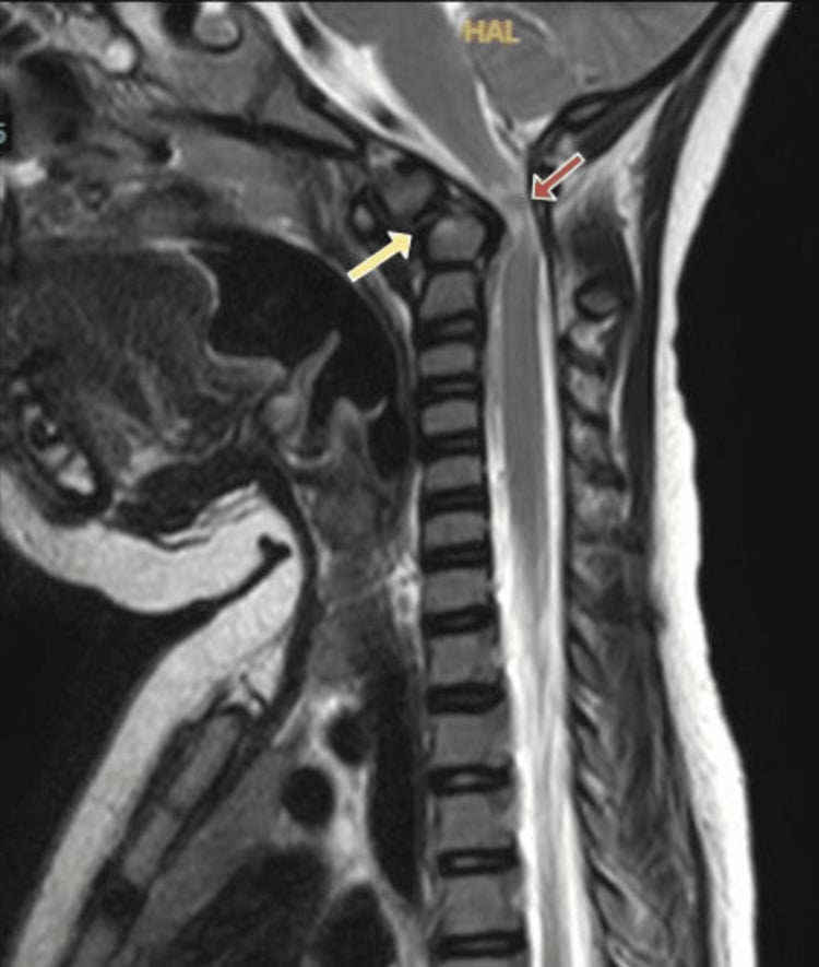 Sagittal T2 cervical MRI showing os odontoideum with severe cervicomedullary compression in a child with Down syndrome