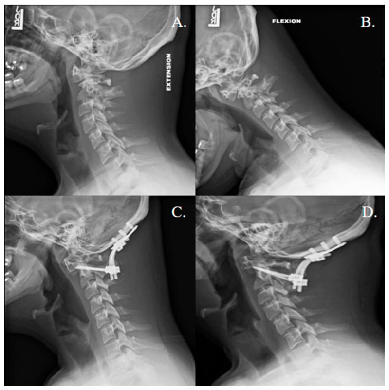 Extension and flexion cervical radiographs with postoperative and one-year C1-C2 fusion views in a patient with Down syndrome