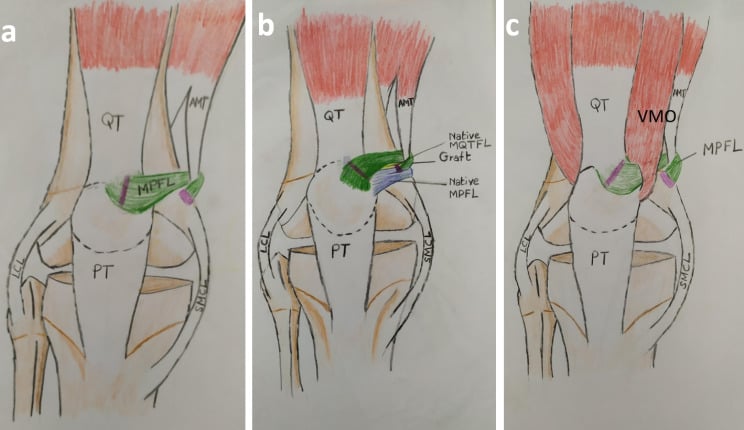 Three-panel schematic of MPFL and adductor magnus tendon reconstruction options for patellar instability