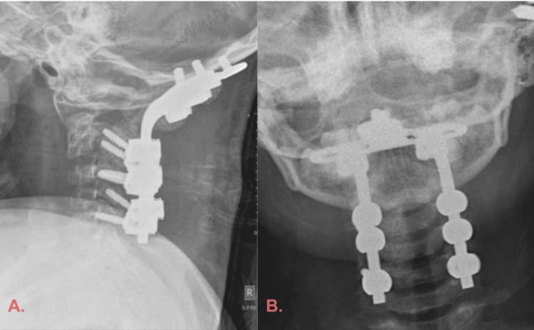 Lateral and AP cervical radiographs after instrumented occipitocervical fixation in a child with Down syndrome