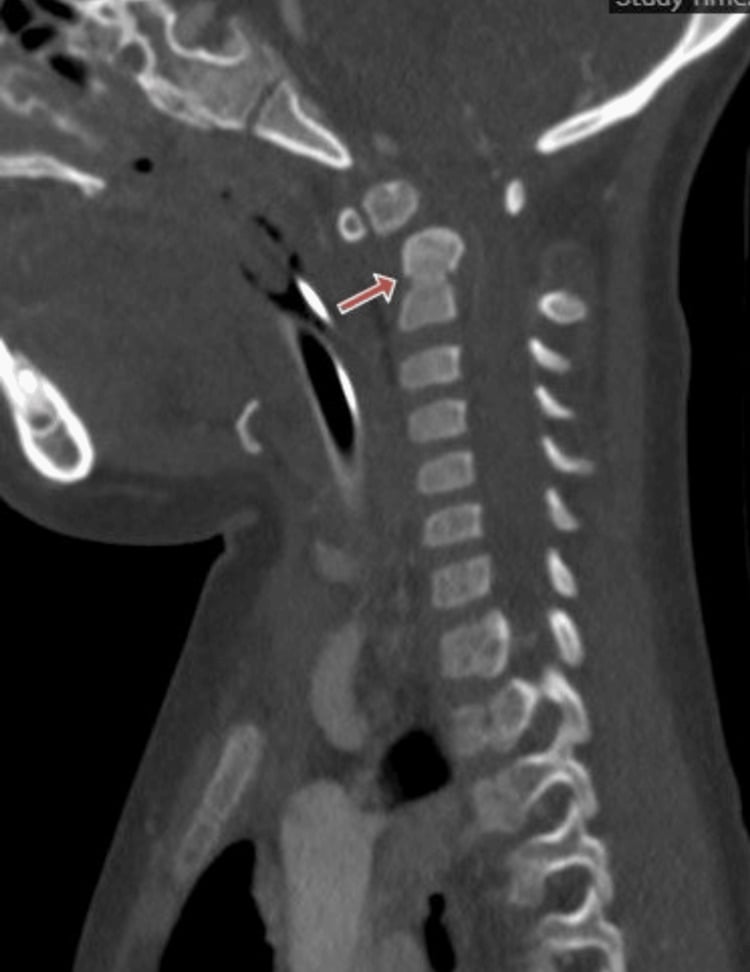 Sagittal CT angiogram showing os odontoideum and atlantoaxial subluxation in a child with Down syndrome