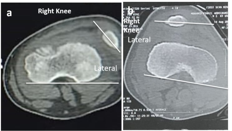 Axial right knee CT before and after reconstruction for patellar instability in a child with Down syndrome
