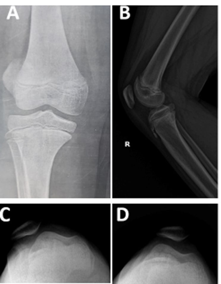 AP lateral and axial knee radiographs before and after treatment of patellar dislocation in a child with Down syndrome