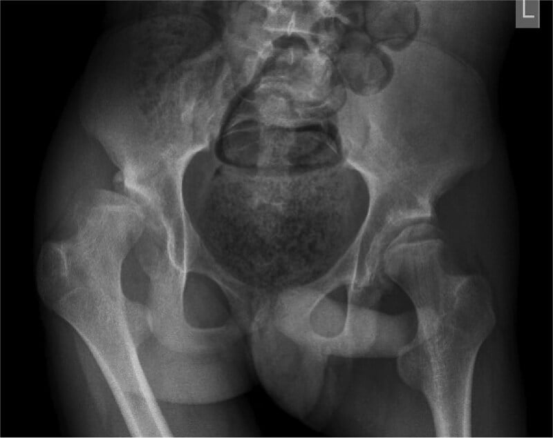 Preoperative AP pelvis radiograph showing severe right neuromuscular hip dysplasia and subluxation