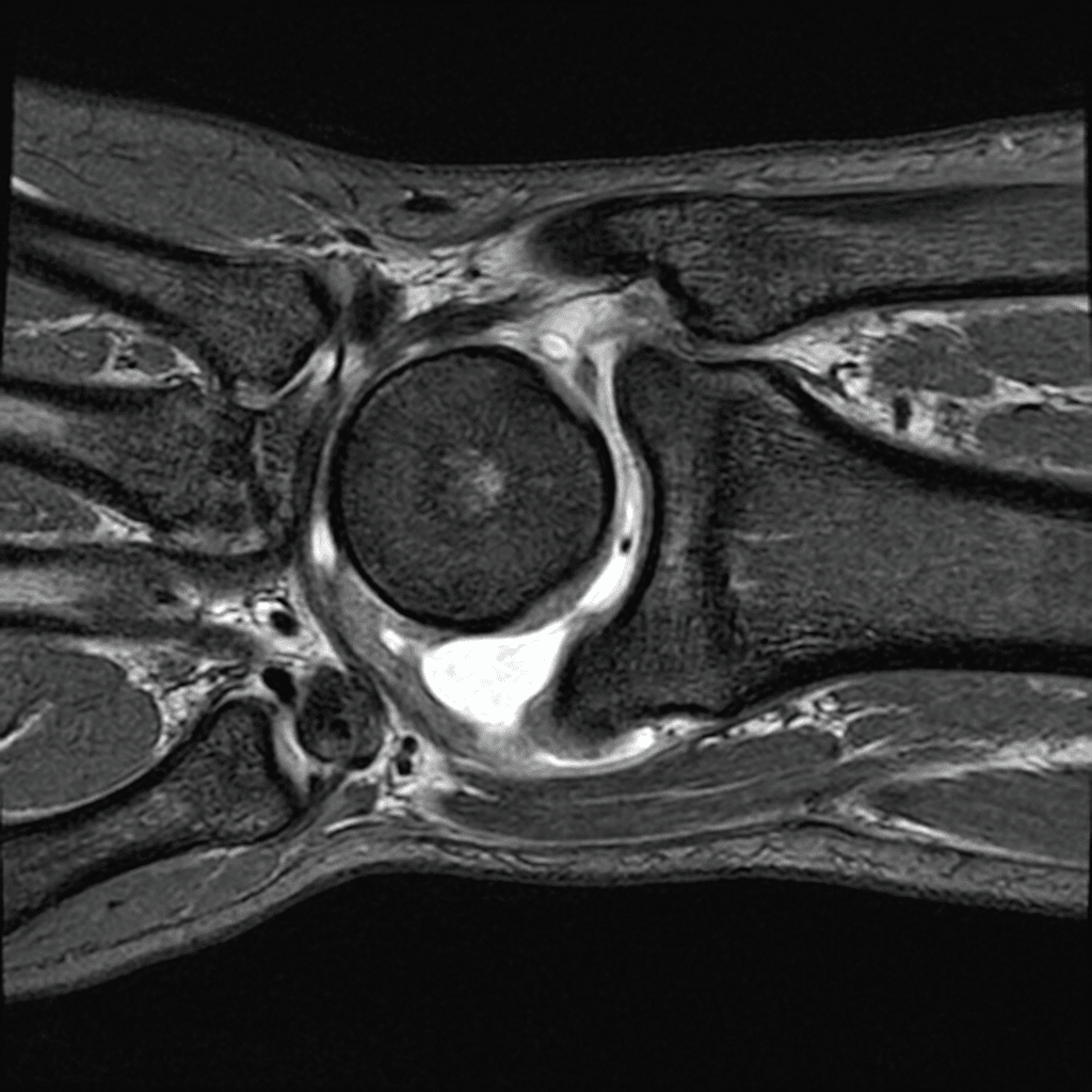 Axial MRI at the level of the distal radioulnar joint showing the ulnar head and sigmoid notch with bright signal at the joint capsule consistent with synovitis.