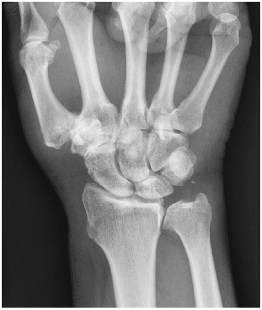 PA radiograph showing DRUJ arthritis with multi-compartment wrist arthritis