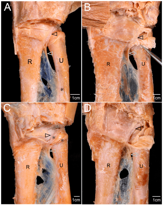 Cadaveric dissections showing attachment of the distal oblique bundle to the proximal margin of the DRUJ articular disc