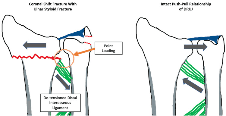 Schematic comparing the intact DRUJ push-pull relationship (right) with a coronal shift distal radius fracture and ulnar styloid fracture (left), labelled point loading and de-tensioned distal interosseous ligament