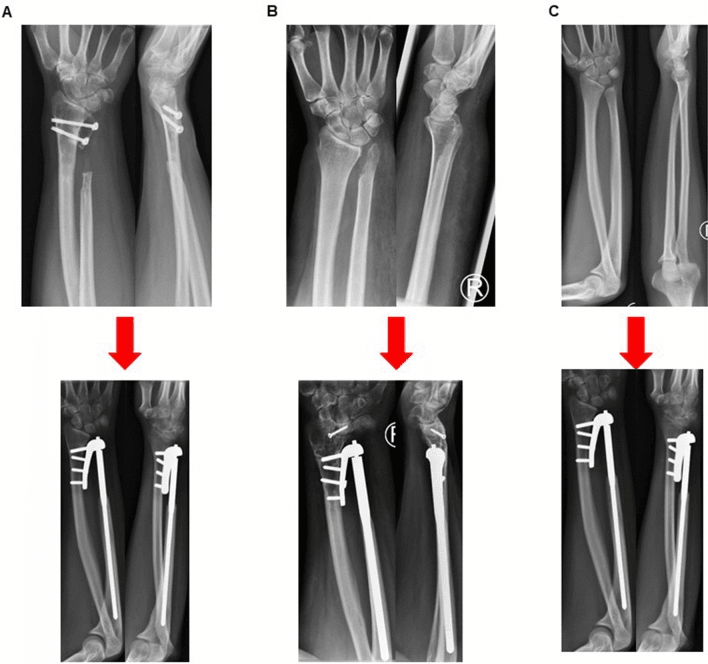 Radiographs of failed Sauve-Kapandji, Bowers and Darrach-type salvages converted to semiconstrained DRUJ arthroplasty