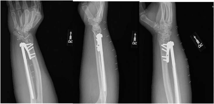 AP, lateral and oblique postoperative radiographs showing a semiconstrained Scheker distal radioulnar joint prosthesis