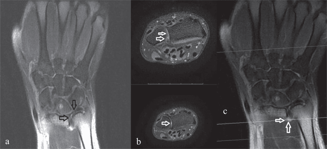 Wrist MRI in three panels, coronal (a, c) and axial (b), with arrows marking the TFCC and fluid in the distal radioulnar joint