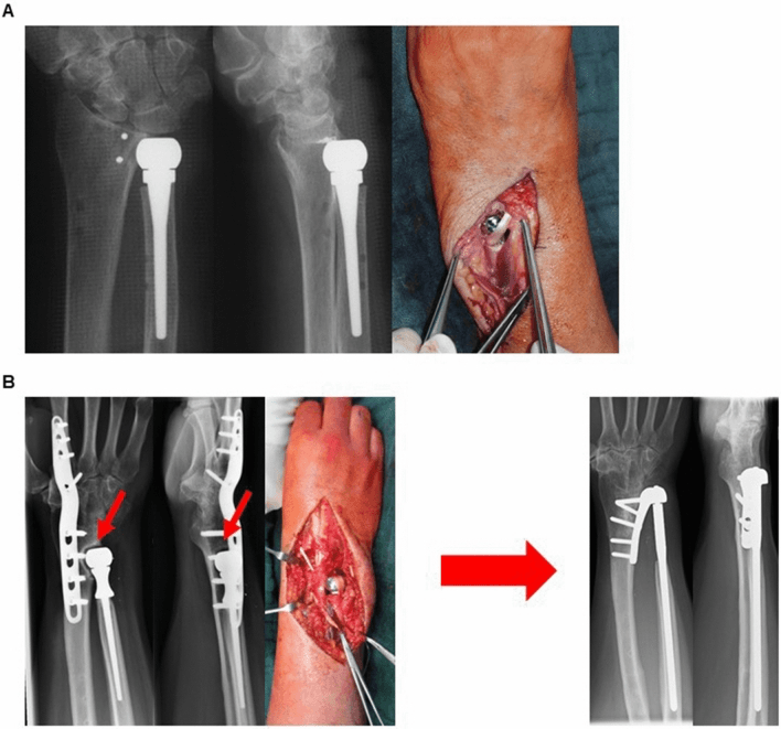 Radiographs and operative photographs of ulnar head prostheses (A, B), in B eroding the distal radius (red arrows) and revised to a semiconstrained DRUJ implant