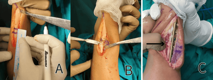 Intraoperative photographs of an ulnar osteotomy for positive ulnar variance after distal radius malunion: marking the level, the osteotomy and plate fixation