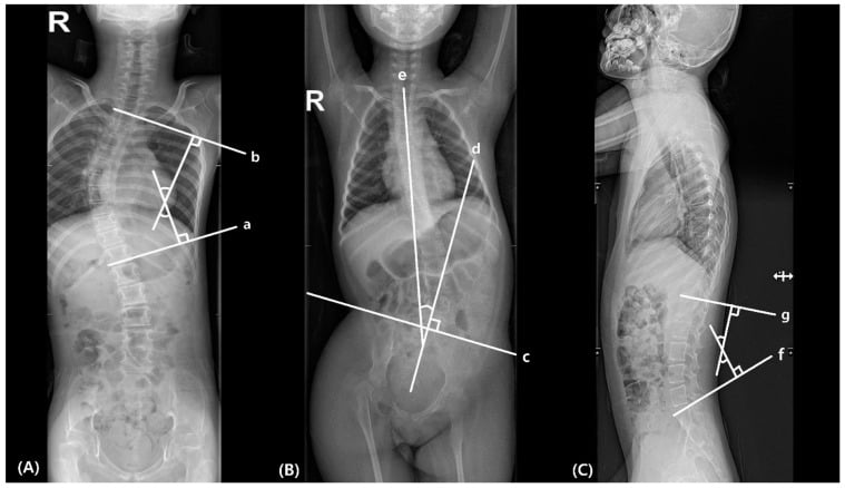 AP and lateral spine radiographs demonstrating Cobb angle, pelvic obliquity and lumbar lordosis measurements in neuromuscular scoliosis.